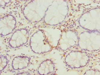 Immunohistochemistry of paraffin-embedded human colon cancer using CSB-PA850277LA01HU at dilution of 1:100