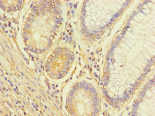 Immunohistochemistry of paraffin-embedded human colon cancer using CSB-PA850291LA01HU at dilution of 1:100