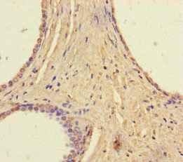Immunohistochemistry of paraffin-embedded human prostate cancer using CSB-PA872547LA01HU at dilution of 1:100 Immunohistochemistry of paraffin-embedded human prostate cancer using CSB-PA872547LA01HU at dilution of 1:100