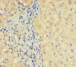 Immunohistochemistry of paraffin-embedded human liver cancer using CSB-PA873688HA01HU at dilution of 1:100