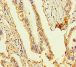Immunohistochemistry of paraffin-embedded human pancreatic cancer using CSB-PA873688HA01HU at dilution of 1:100