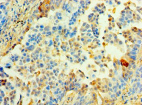 Immunohistochemistry of paraffin-embedded human lung cancer using CSB-PA874841HA01HU at dilution of 1:100