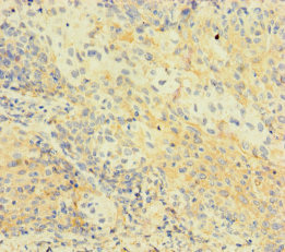 Immunohistochemistry of paraffin-embedded human cervical cancer using CSB-PA878881LA01HU at dilution of 1:100