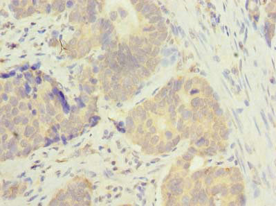 Immunohistochemistry of paraffin-embedded human gastric cancer using CSB-PA880106LA01HU at dilution of 1:100