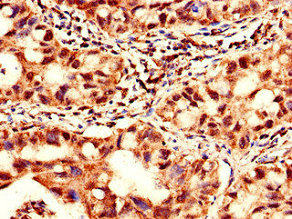 Immunohistochemistry of paraffin-embedded human lung cancer using CSB-PA896902LA01HU at dilution of 1:100
