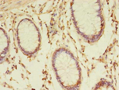 Immunohistochemistry of paraffin-embedded human colon cancer using CSB-PA897107LA01HU at dilution of 1:100