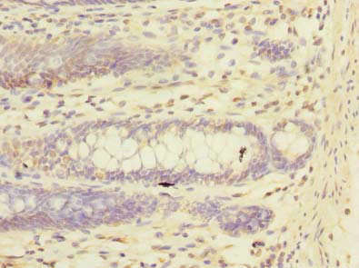Immunohistochemistry of paraffin-embedded human colon cancer using CSB-PA897559LA01HU at dilution of 1:100