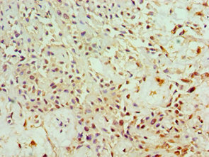 Immunohistochemistry of paraffin-embedded human breast cancer using CSB-PA001845ESR2HU at dilution of 1:100