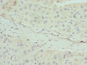 Immunohistochemistry of paraffin-embedded human liver cancer using CSB-PA001947ESR2HU at dilution of 1:100
