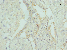 Immunohistochemistry of paraffin-embedded human lung cancer using CSB-PA001947ESR2HU at dilution of 1:100