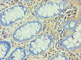 Immunohistochemistry of paraffin-embedded human colon cancer using CSB-PA002358ESR1HU at dilution of 1:100