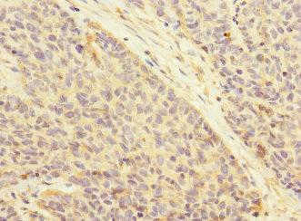 Immunohistochemistry of paraffin-embedded human ovarian cancer using CSB-PA002435ESR1HU at dilution of 1:100
