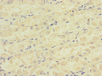 Immunohistochemistry of paraffin-embedded human gastric cancer using CSB-PA002435ESR1HU at dilution of 1:100