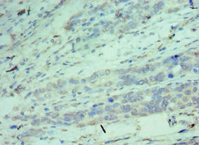 Immunohistochemistry of paraffin-embedded human endometrial cancer using CSB-PA005079ESR1HU at dilution of 1:100