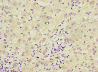 Immunohistochemistry of paraffin-embedded human liver cancer using CSB-PA006563ESR2HU at dilution of 1:100