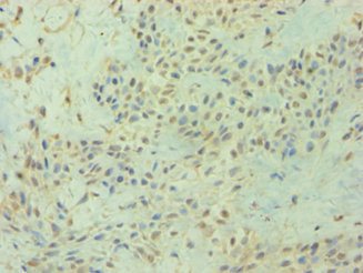 Immunohistochemistry of paraffin-embedded human breast cancer using CSB-PA006907ESR2HU at dilution of 1:100