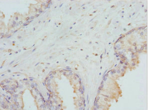 Immunohistochemistry of paraffin-embedded human prostate cancer using CSB-PA006953DSR2HU at dilution of 1:100