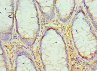 Immunohistochemistry of paraffin-embedded human colon cancer using CSB-PA007408ESR1HU at dilution of 1:100