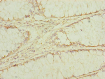 Immunohistochemistry of paraffin-embedded human colon cancer using CSB-PA007433ESR1HU at dilution of 1:100