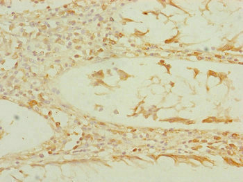Immunohistochemistry of paraffin-embedded human colon cancer using CSB-PA007433ESR2HU at dilution of 1:100