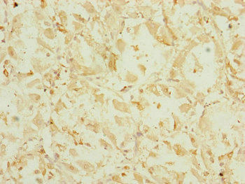 Immunohistochemistry of paraffin-embedded human gastric cancer using CSB-PA007433ESR2HU at dilution of 1:100