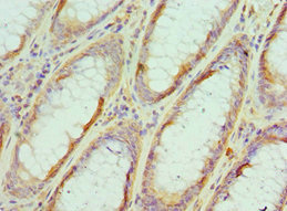 Immunohistochemistry of paraffin-embedded human colon cancer using CSB-PA007550ESR1HU at dilution of 1:100