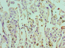 Immunohistochemistry of paraffin-embedded human lung cancer using CSB-PA007550ESR1HU at dilution of 1:100