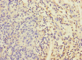 Immunohistochemistry of paraffin-embedded human bladder cancer using CSB-PA007558ESR1HU at dilution of 1:100