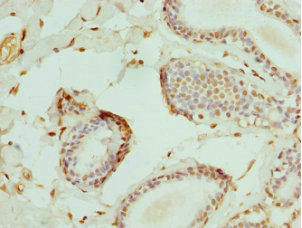 Immunohistochemistry of paraffin-embedded human breast cancer using CSB-PA007596DSR2HU at dilution of 1:100 Immunohistochemistry of paraffin-embedded human breast cancer using CSB-PA007596DSR2HU at dilution of 1:100