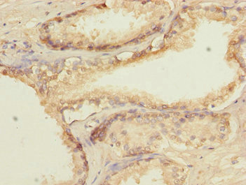 Immunohistochemistry of paraffin-embedded human prostate cancer using CSB-PA010000ESR1HU at dilution of 1:100