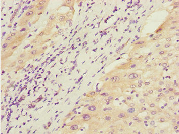 Immunohistochemistry of paraffin-embedded human liver cancer using CSB-PA010000ESR1HU at dilution of 1:100 Immunohistochemistry of paraffin-embedded human liver cancer using CSB-PA010000ESR1HU at dilution of 1:100