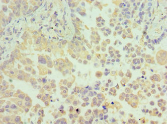 Immunohistochemistry of paraffin-embedded human lung cancer using CSB-PA010286ESR1HU at dilution of 1:100 Immunohistochemistry of paraffin-embedded human lung cancer using CSB-PA010286ESR1HU at dilution of 1:100