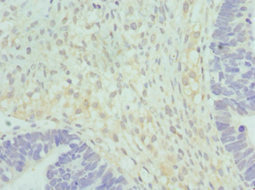 Immunohistochemistry of paraffin-embedded human ovarian cancer using CSB-PA010772ESR1HU at dilution of 1:100