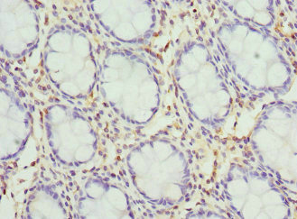 Immunohistochemistry of paraffin-embedded human colon cancer using CSB-PA012035DSR2HU at dilution of 1:100