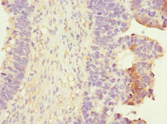 Immunohistochemistry of paraffin-embedded human ovarian cancer using CSB-PA019297ESR2HU at dilution of 1:100