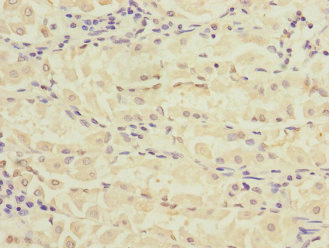 Immunohistochemistry of paraffin-embedded human gastric cancer using CSB-PA020104ESR1HU at dilution of 1:100