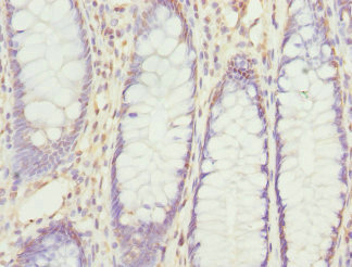 Immunohistochemistry of paraffin-embedded human colon cancer using CSB-PA020474ESR1HU at dilution of 1:100