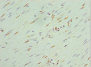 Immunohistochemistry of paraffin-embedded human colon cancer using CSB-PA021015ESR2HU at dilution of 1:100