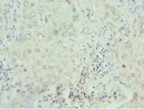 Immunohistochemistry of paraffin-embedded human lung cancer using CSB-PA021015ESR2HU at dilution of 1:100