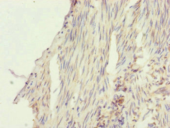 Immunohistochemistry of paraffin-embedded human bladder cancer using CSB-PA021132ESR2HU at dilution of 1:100