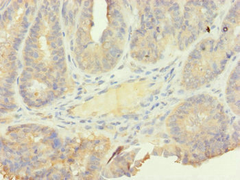 Immunohistochemistry of paraffin-embedded human endometrial cancer using CSB-PA021132ESR2HU at dilution of 1:100