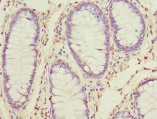 Immunohistochemistry of paraffin-embedded human colon cancer using CSB-PA021355DSR2HU at dilution of 1:100 Immunohistochemistry of paraffin-embedded human colon cancer using CSB-PA021355DSR2HU at dilution of 1:100