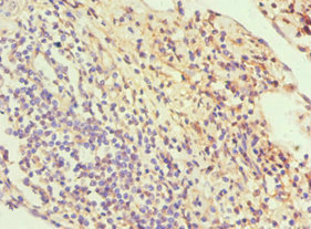 Immunohistochemistry of paraffin-embedded human cervical cancer using CSB-PA021546ESR2HU at dilution of 1:100