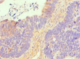 Immunohistochemistry of paraffin-embedded human ovarian cancer using CSB-PA021546ESR2HU at dilution of 1:100