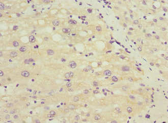 Immunohistochemistry of paraffin-embedded human liver cancer using CSB-PA022432DSR2HU at dilution of 1:100