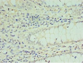 Immunohistochemistry of paraffin-embedded human colon cancer using CSB-PA022434DSR2HU at dilution of 1:100 Immunohistochemistry of paraffin-embedded human colon cancer using CSB-PA022434DSR2HU at dilution of 1:100