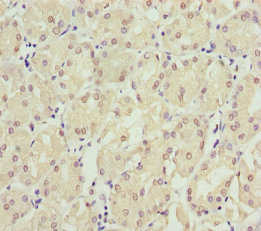 Immunohistochemistry of paraffin-embedded human gastric cancer using CSB-PA022583ESR1HU at dilution of 1:100 Immunohistochemistry of paraffin-embedded human gastric cancer using CSB-PA022583ESR1HU at dilution of 1:100
