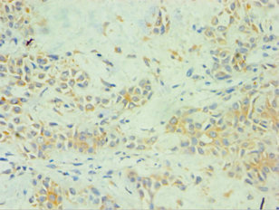 Immunohistochemistry of paraffin-embedded human breast cancer using CSB-PA022584ESR1HU at dilution of 1:100 Immunohistochemistry of paraffin-embedded human breast cancer using CSB-PA022584ESR1HU at dilution of 1:100