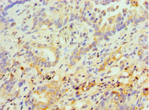 Immunohistochemistry of paraffin-embedded human lung cancer using CSB-PA022590ESR1HU at dilution of 1:100