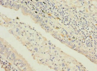 Immunohistochemistry of paraffin-embedded human lung cancer using CSB-PA022793ESR2HU at dilution of 1:100